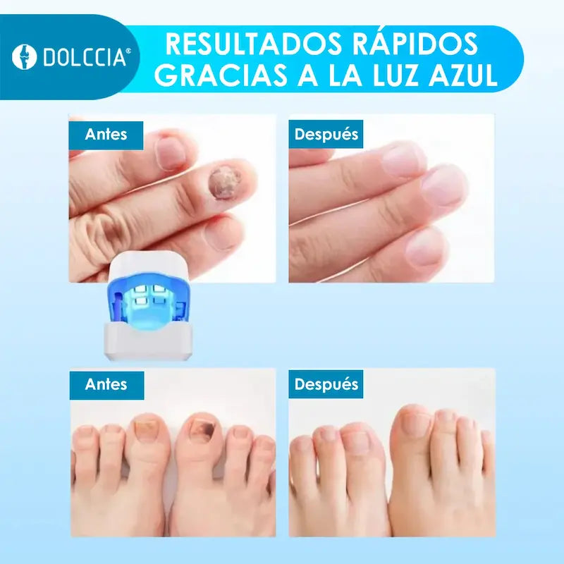 LÁSER ANTIHONGOS ™